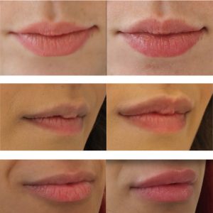 Lip fillers Before and After