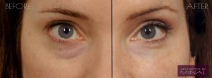 under eye dark circles - watford