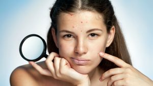 Acne spots watford