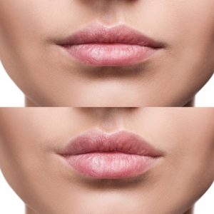 Lip Filler Watford