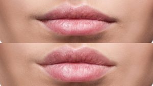Lip filler watford