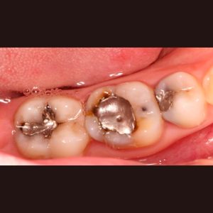 Amalgam Fillings