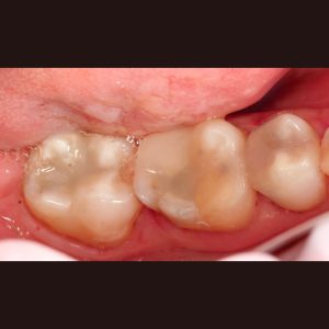 Composite Fillings